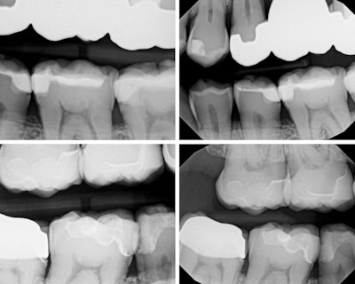 Figure 2: Four identical bitewings, same exposure, taken from the same patient using another intraoral sensor.