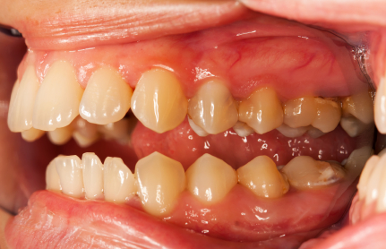 Teeth Periodontal Disease