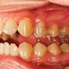 Teeth Periodontal Disease