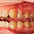 Teeth Periodontal Disease