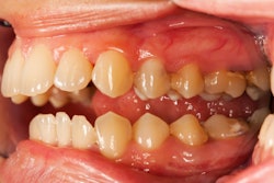 Teeth Periodontal Disease
