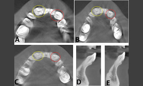 2026 01 15 Case Report Fused Teeth 400