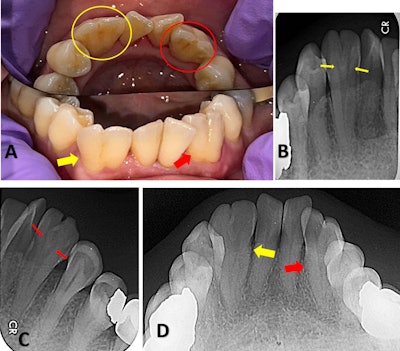 (A) Intraoral photograph showing bilaterally fused mandibular lateral incisors and canines with visible developmental grooves on the labial surfaces and mild tooth surface loss in relation to teeth #42 and #43. (B,C) Intraoral periapical radiographs demonstrating bilateral fusion of the mandibular lateral incisors and canines, with two distinct coronal pulp horns converging into a single pulp chamber at the cervical level. (D) Mandibular occlusal radiograph confirming bilateral fusion of the lateral incisors and canines.
