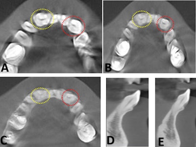 (A-C) show axial CBCT images at the cervical, middle, and apical thirds of the root, respectively, of the fused right and left lateral incisors and canines exhibiting a single pulp chamber and a single root. (D, E) show sagittal CBCT sections demonstrating similar crown and root morphology of the fused lateral incisor and canine on both sides. Minor image noise was noted, partially obscuring fine internal details of the root canals; nevertheless, the diagnostic interpretation remained unaffected.