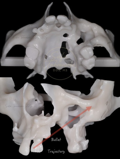 Figure 3: A forensic bone model demonstrates the bullet's trajectory and resulting damage to the man's mouth.