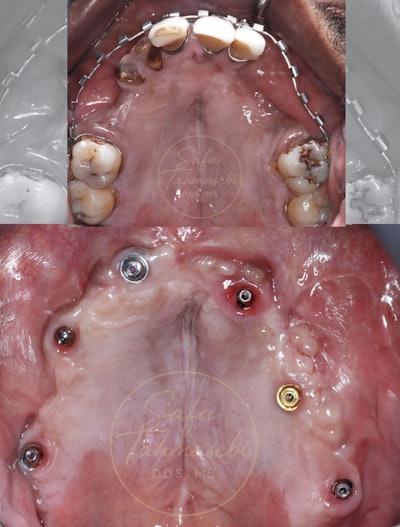 Figure 4: John Doe's existing teeth were extracted and replaced with a maxillary full-arch implant.