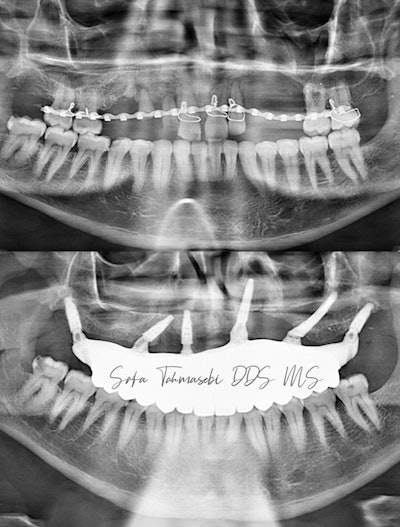Figure 5: Before and after panoramic x-ray of John Doe's teeth.