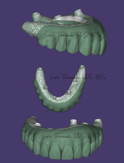 Figure 7: 3D dental model of the maxillary full-arch implant.