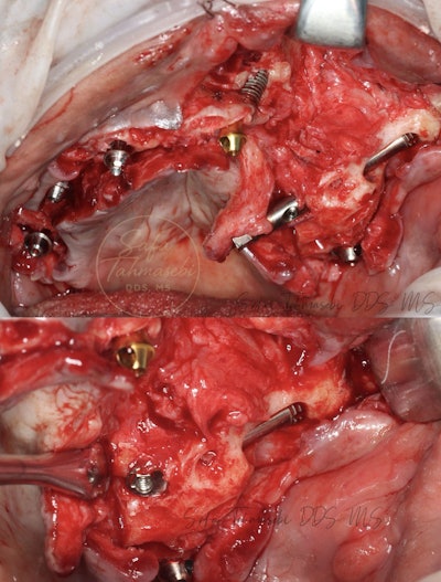 Figure 8: There was limited but viable enough bone to support a full-arch implant reconstruction.