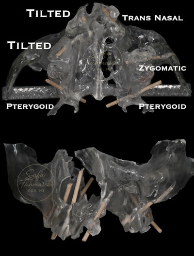 Figure 9: An anatomical model demonstrates how Dr. Tahmasebi reconstructed John Doe's maxilla.
