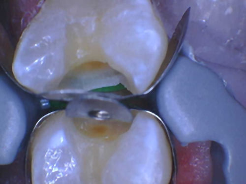 Figure 1: I don&rsquo;t think I sealed that gingival margin.