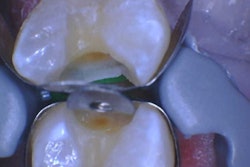 Figure 1: I don’t think I sealed that gingival margin.