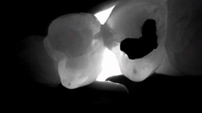 Figure 9: This is the interproximal space between teeth #s12 and 13. Notice that, upon learning the location of these interproximal lesions, the practitioner doesn’t have to prepare the lingual extent of the interproximal box.