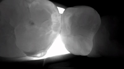 Figure 10: This is the interproximal space between teeth #20 and #21. Notice that both lesions are incipient and do not extend into the dentin. This provided further confirmation that a traditional class II prep would not be appropriate.