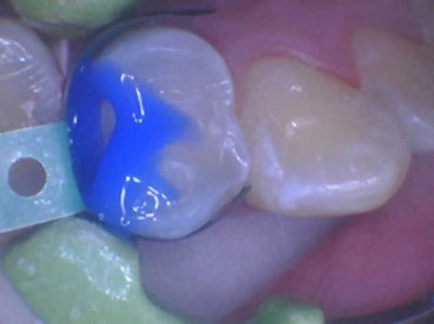 Figure 2: The etch may have “splushed” a bit here.