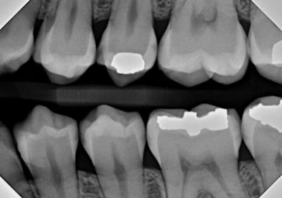 Figure 4: Traditional bitewing radiography indicates clear decay on tooth #13, with some evidence of incipient lesions on #s 12, 14, 18, 19, 20, and 21. It is quite possible for me to miss one or more of these lesions on the lower teeth during busy times at the office.