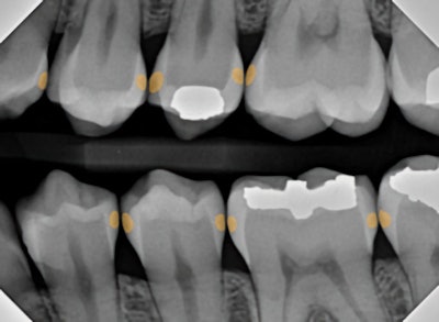 Figure 5: AI radiographic interpretation helps highlight lesions and provides insight as to the extent of the decay.