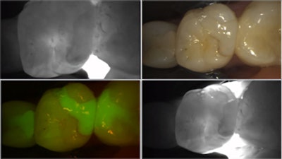 Figure 7: Evaluating the marginal seal of an old resin filling. Transillumination shows some leakage, and the red fluorescence signal shows bacterial activity.