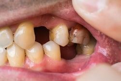 Dental Problems Phot Oleh