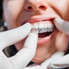 Dentist Installing Aligner Karrastock