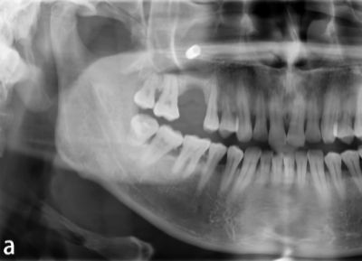 2026 02 18 Displaced Implant Systemic Complications 400