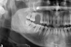 2026 02 18 Displaced Implant Systemic Complications 400