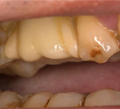 Figure 1: Dental implant proximal and distal mesial surfaces bonded to neighboring teeth with resin.