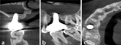 Figure 2 (a-c): Cone-beam computed tomography (CBCT) scans taken at the initial consultation showed partial entry of the implant into the maxillary sinus, incomplete osseointegration, inflammation in the maxillary sinus, and the implant crown connecting with the neighboring tooth without a gap, (a) coronal view, (b) sagittal view, and (c) axial view.
