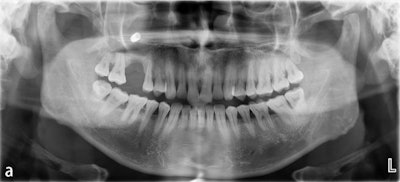 Figure 3: (a) Panoramic slice view after removal of the visible implant in the mouth showing the presence of another implant in the maxillary sinus.