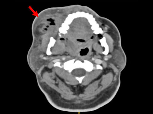2026 02 26 Odontogenic Infection Gas 400