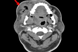 2026 02 26 Odontogenic Infection Gas 400