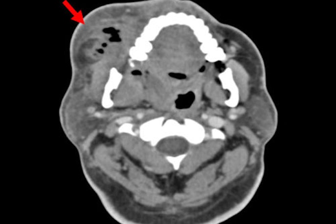 2026 02 26 Odontogenic Infection Gas 400