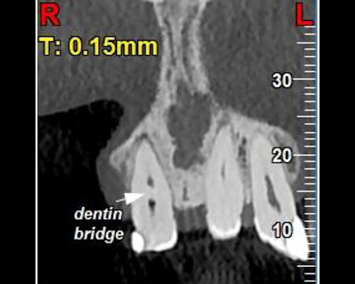 2026 03 02 Spontaneous Dentin Bridge 400