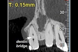 2026 03 02 Spontaneous Dentin Bridge 400