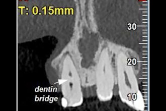2026 03 02 Spontaneous Dentin Bridge 400
