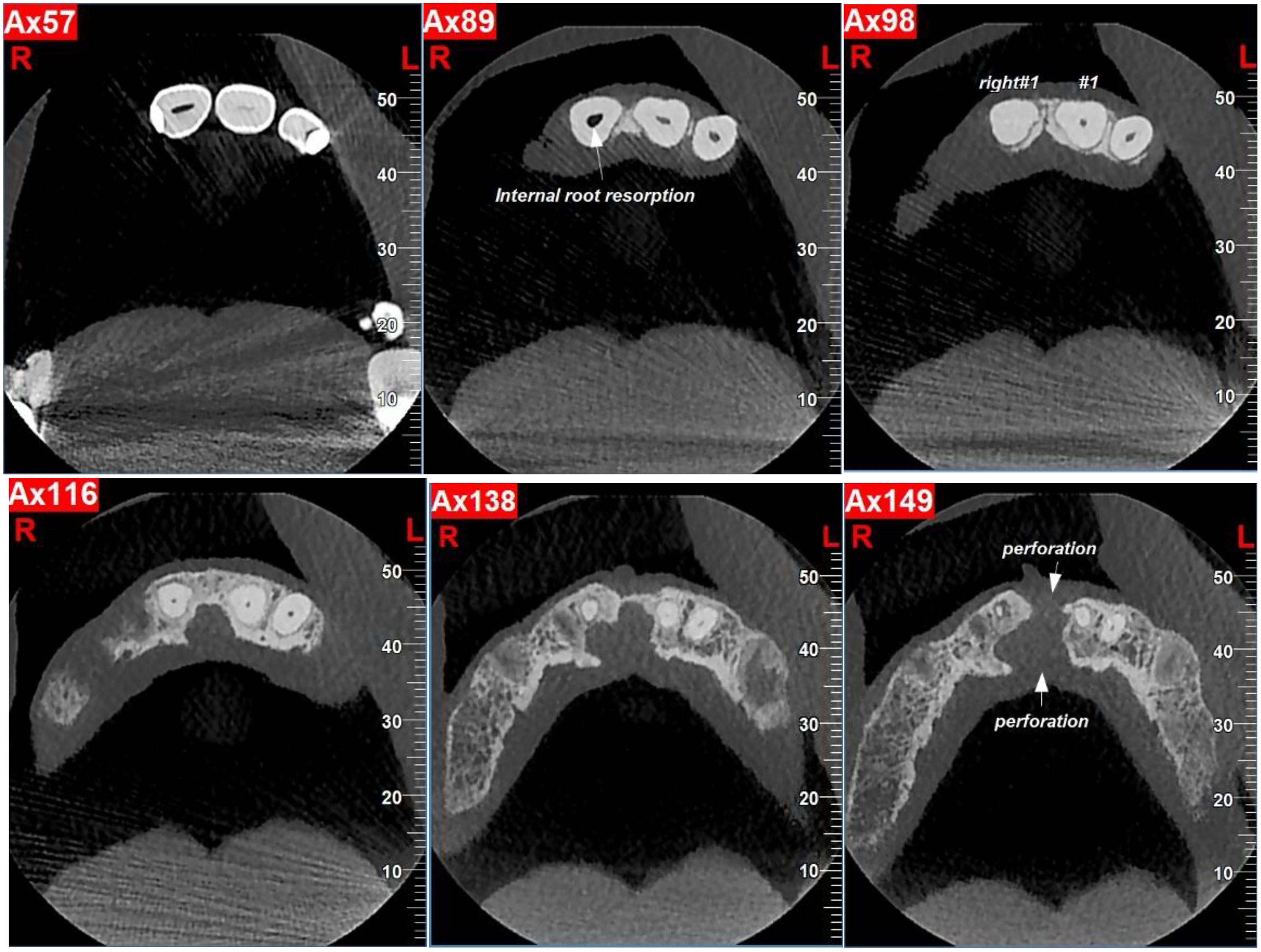 Rare spontaneous dentin bridge forms after dental trauma | DrBicuspid.com