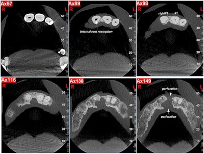Figure 2: Occlusal views of CBCT images showing internal root resorption, bone loss, and perforation of the cortical plates.