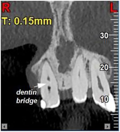 Figure 3: Coronal view of a CBCT image shows the dentin bridge separating the necrotic coronal pulp from the vital apical pulp.