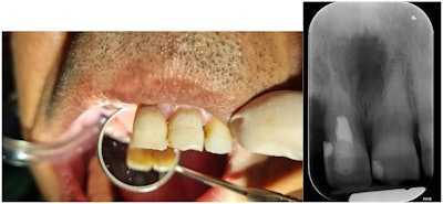Figure 4: Photo and periapical radiography after root canal therapy and tooth restoration.