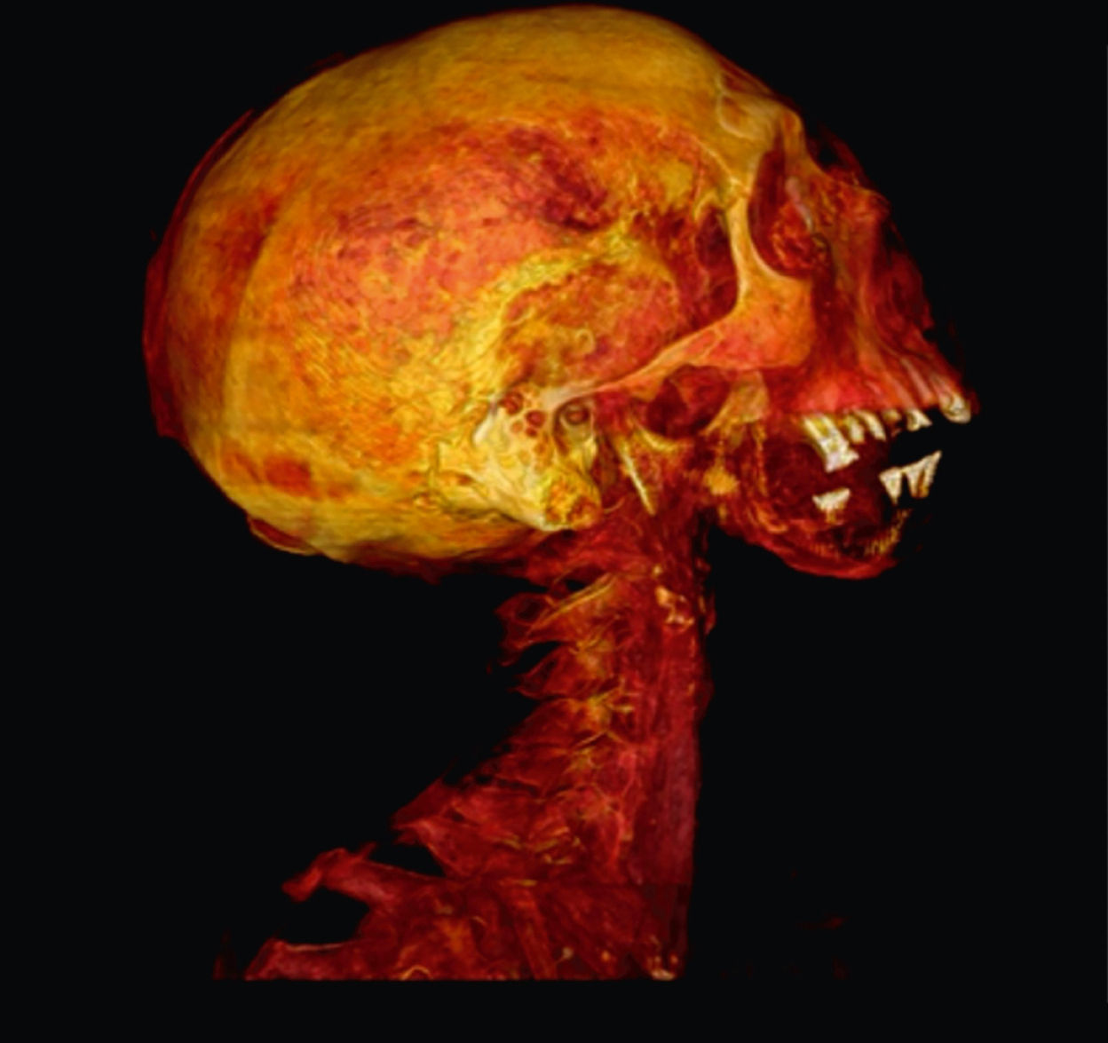 2026 03 03 Perio Cvd In Mummies 400