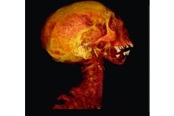 2026 03 03 Perio Cvd In Mummies 400