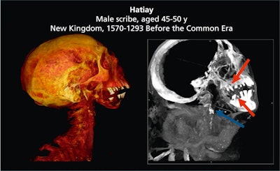 Figure 1: Computed tomographic scans of Hatiay, a mummy included in the original Horus work, with evidence of both carotid calcifications (blue arrow) and poor dental health (red arrows).