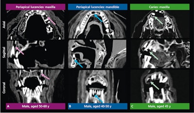 Figure 2: Periapical lucencies in the maxilla (purple arrows) (A) and mandible (blue arrows) (B) and caries (green arrows) (C) as viewed in the axial, sagittal, and coronal planes via computed tomography of three male mummies.