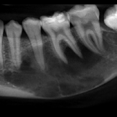 25 Yo Man Mandibuar Lesion 400