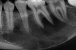 25 Yo Man Mandibuar Lesion 400