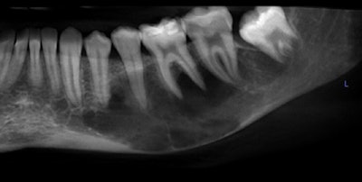 Figure 1: Cropped, reformatted panoramic film of the left mandible.