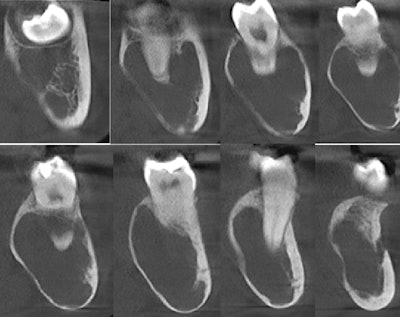 Figure 2: CBCT coronal images of the left posterior mandible.