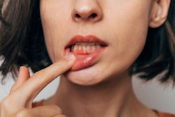 Gum Inflammation My Ocean Studio