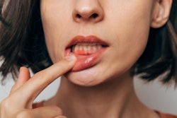 Gum Inflammation My Ocean Studio