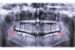 Third Molar Kabardins Photo